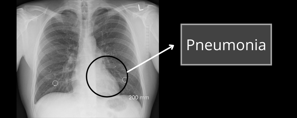 Pneumonia Detection